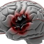 brain hemorrhage - what causes a brain bleed