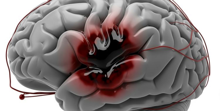 brain hemorrhage - what causes a brain bleed